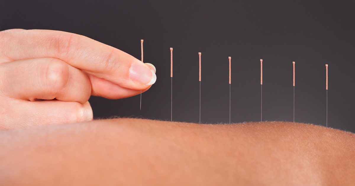 Acupuncture Treatment